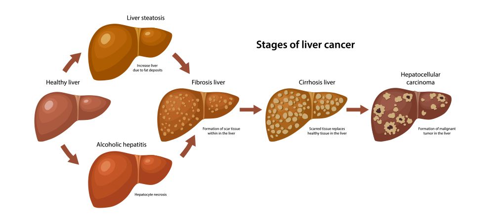 liver disease